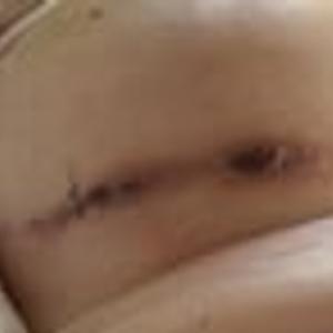 Preview thumbnail for Incision not looking good 7 weeks post op