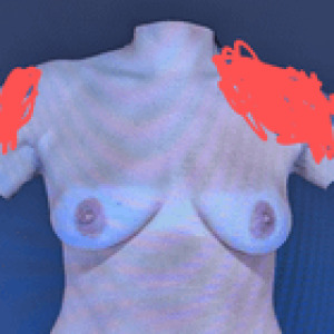 Preview thumbnail for 475 cc One year post op