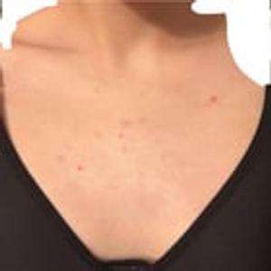 Preview thumbnail for Growing acne on chest 3wpo