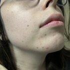 Preview thumbnail for Did Tret give me perioral dermatitis or is my skin barrier broken? 