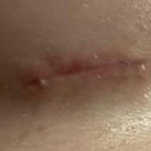 Preview thumbnail for Has anyone here had a stitch end “peek” through the skin weeks post surgery?