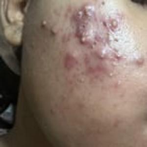 Preview thumbnail for 2 months into. 025 tretinoin gel.. Feeling like giving up